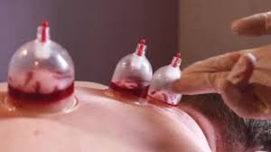 Cupping and Massagae