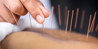 Acupuncture Treatment and Training Course